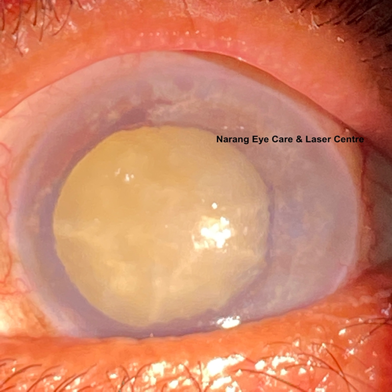 Lasik Surgery Vijay Cross Road  
