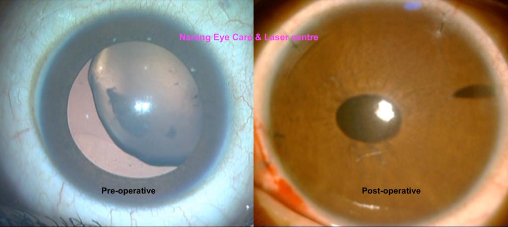 Contact Lens Surgery Ahmedabad  